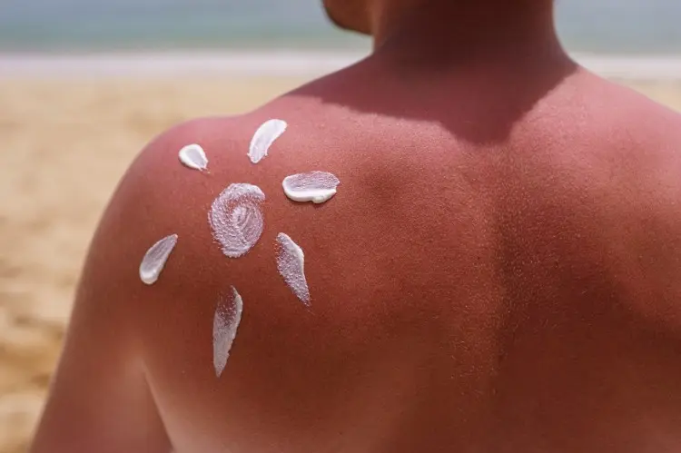 Can You Use Hypochlorous Acid to Treat Sunburn? Can You Use Hypochlorous Acid to Treat Sunburn?
