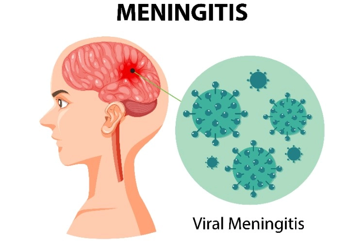HOCl vs Meningitis Outbreak